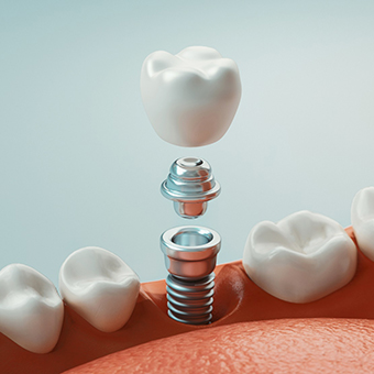 diagram of a single implant, showing the individual parts