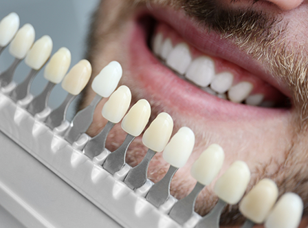 Shade matching for teeth whitening