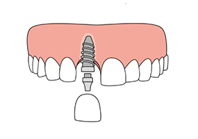 Illustration of dental crown being attached to dental implant