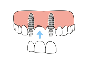 Illustration of dental bridge being attached to dental implants