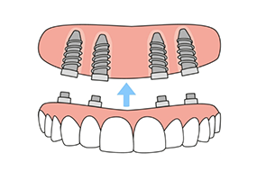 Illustration of dentures being attached to dental implants