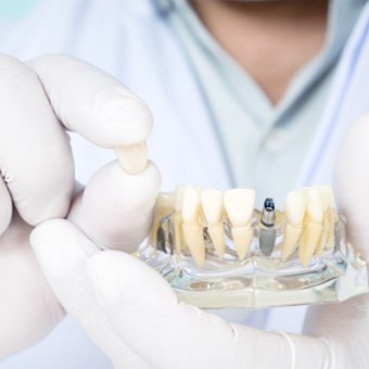 Dentist holding a model of a dental implant