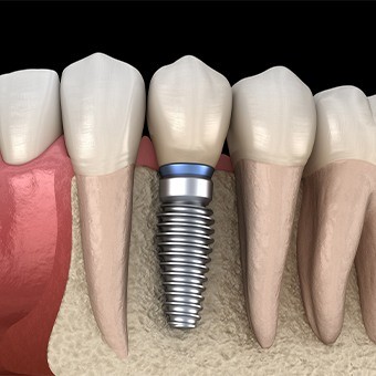 Animated dental implant with dental crown replacing one missing tooth