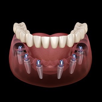 Animated implant denture