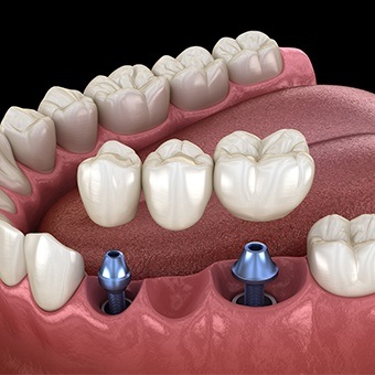 Animated dental implant bridge