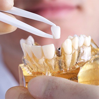 Dentist placing a dental crown on a dental implant in a model of the mouth