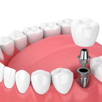 3D graphic of dental implant