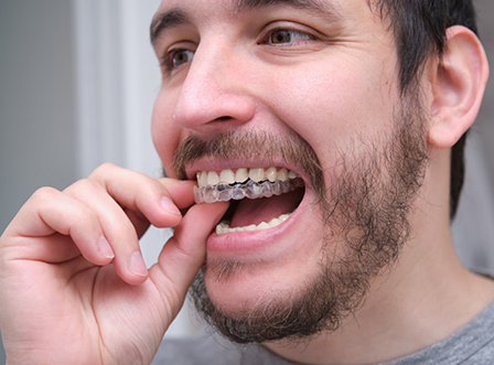 Man placing Invisalign aligners over upper teeth