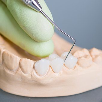 Model of the mouth with dental bridge over three of the teeth