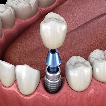 Animated dental implant with dental crown replacing a missing tooth