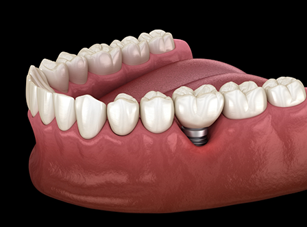 Illustration of dental implant in lower jaw