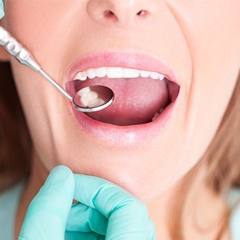 Closeup of dental mirror in mouth during dental checkup