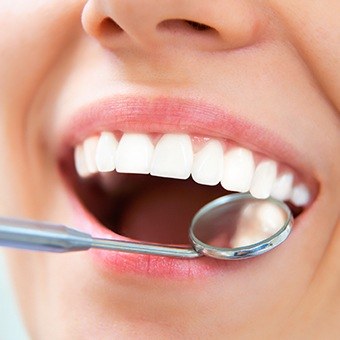 Closeup of dental mirror in mouth during dental exam