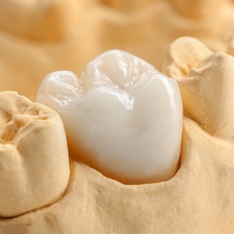 Model of the mouth with dental crown