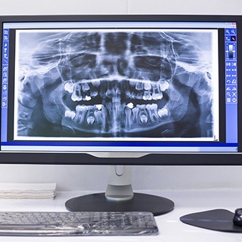 Panoramic digital dental x rays on computer screen