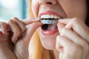 Woman inserting top Invisalign tray